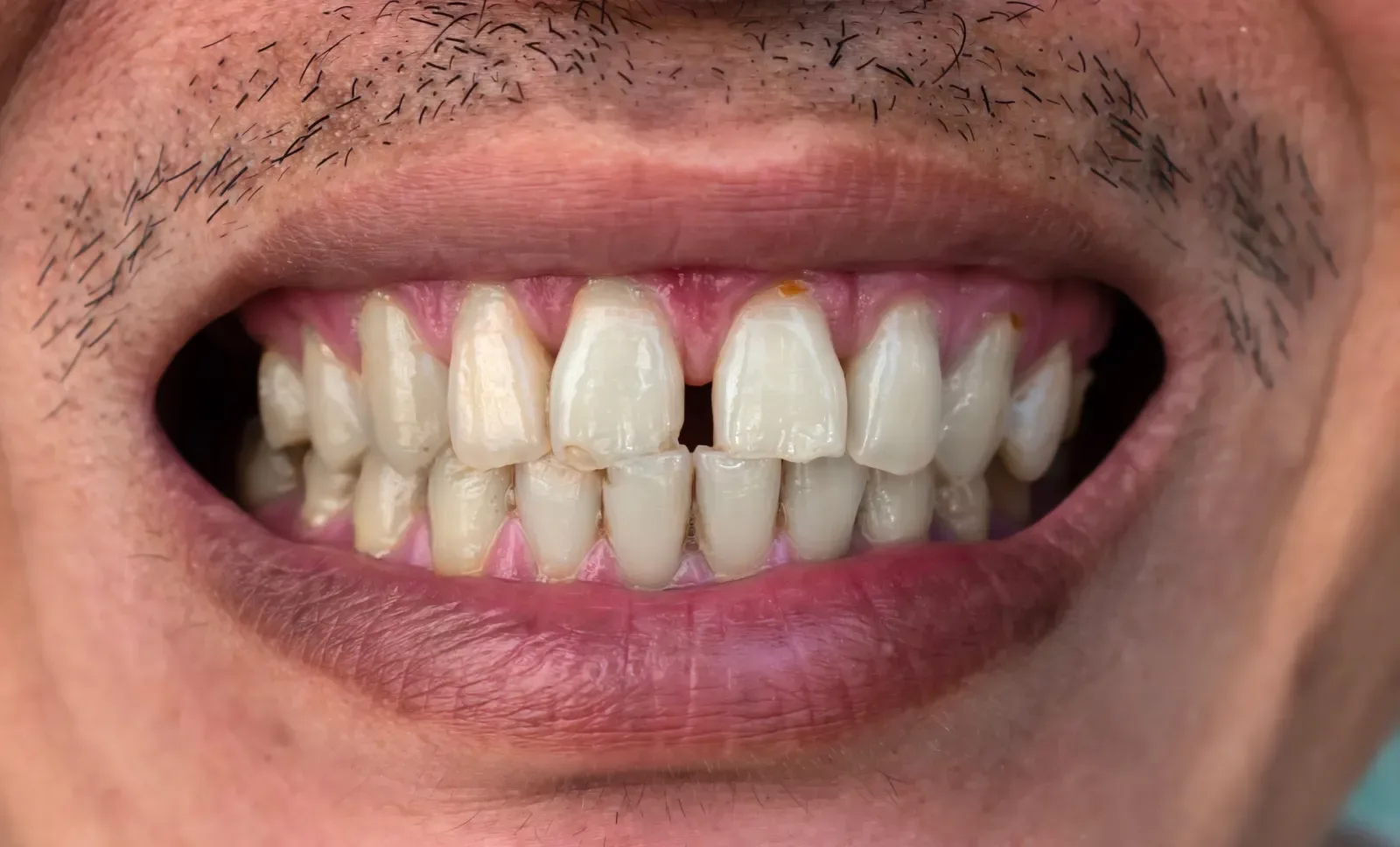 Gaps in Teeth