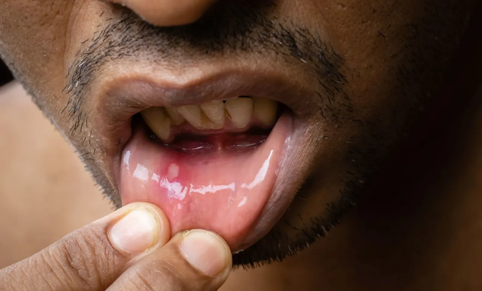 Mouth Ulcers