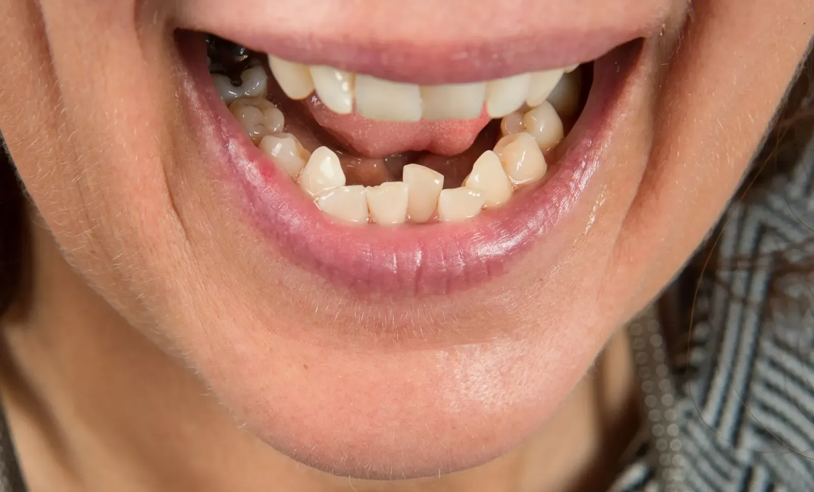 Teeth Crowding