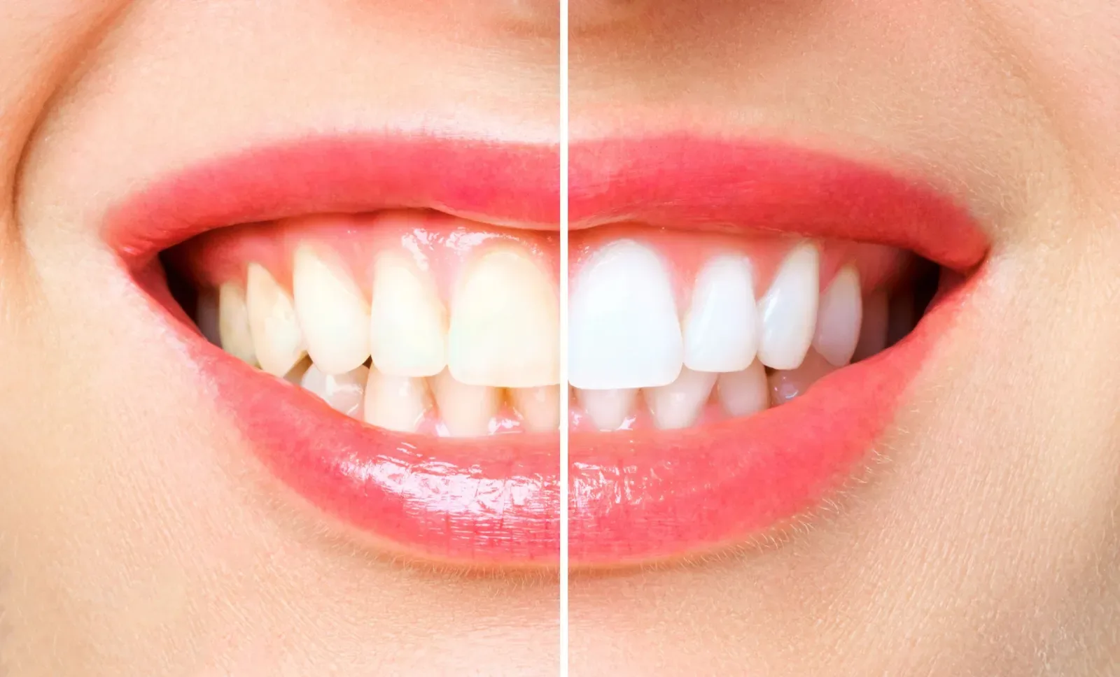 Teeth Discolouration
