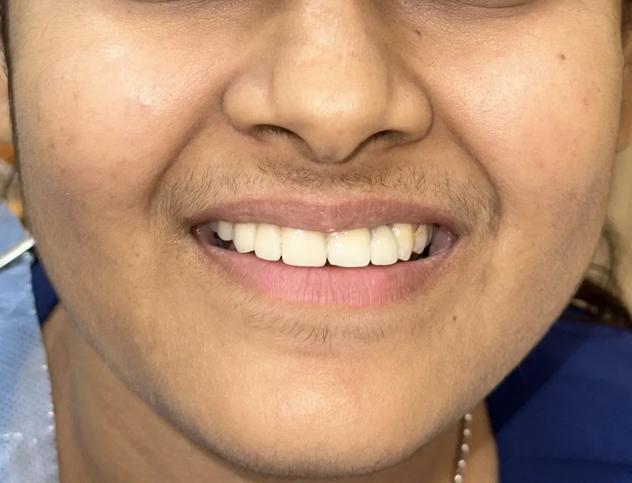 Smile Makeover — after treatment at Shayona Dental