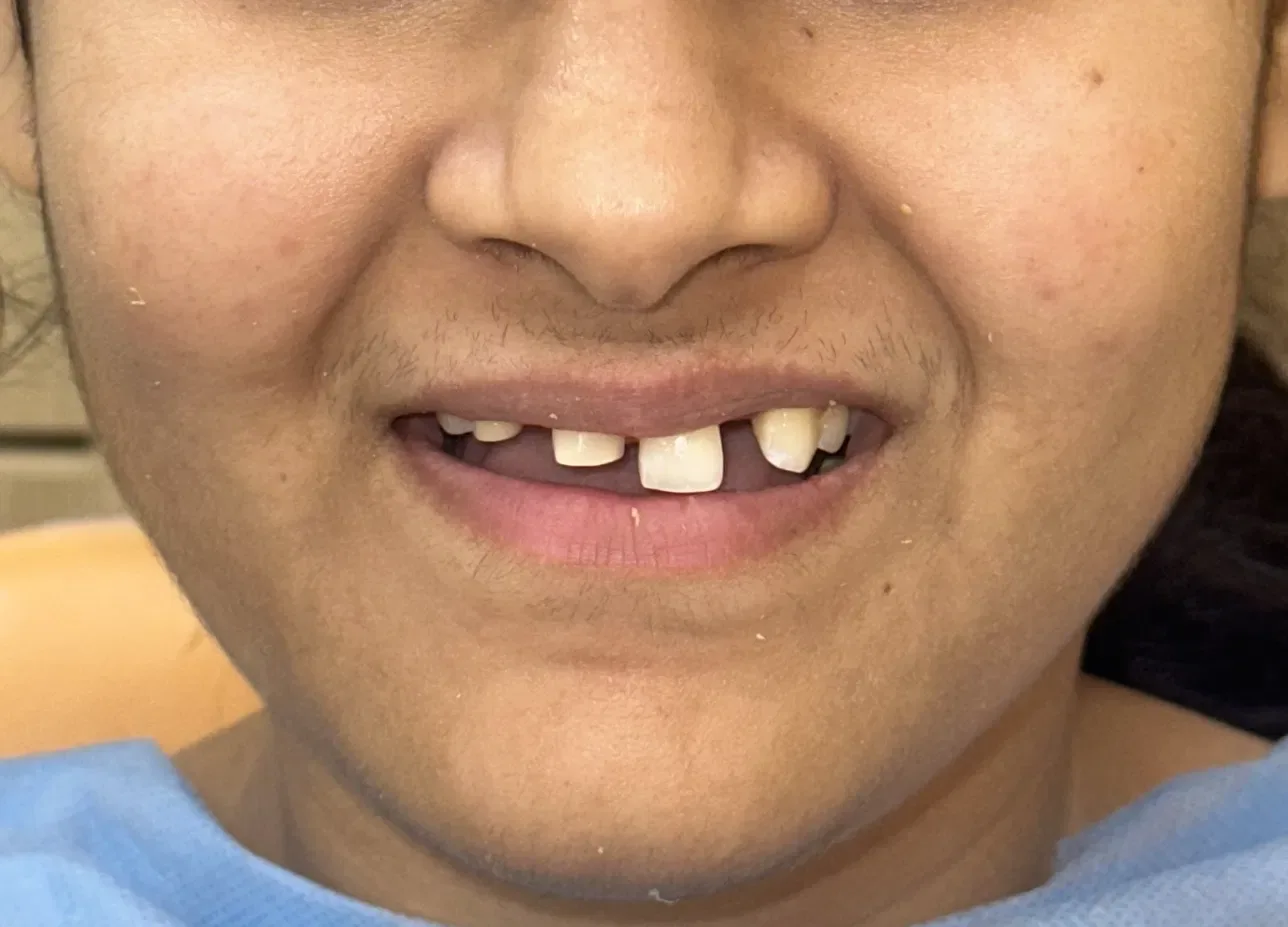 Smile Makeover — before treatment at Shayona Dental
