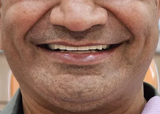 Full Smile Restoration — after treatment at Shayona Dental