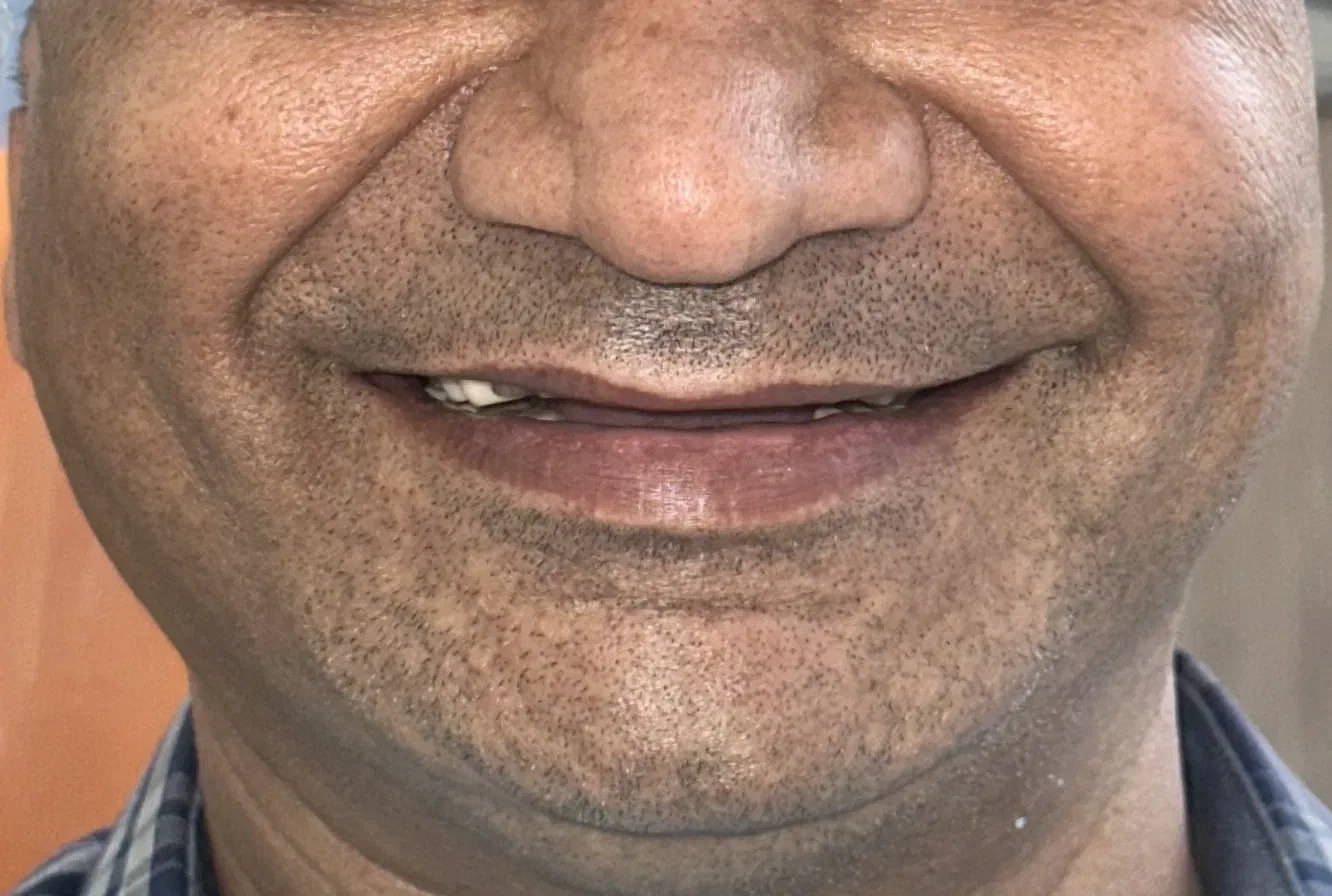 Full Smile Restoration — before treatment at Shayona Dental