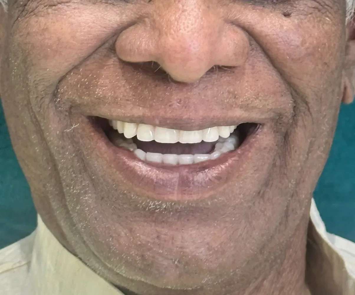 Full Mouth Rehabilitation — after treatment at Shayona Dental
