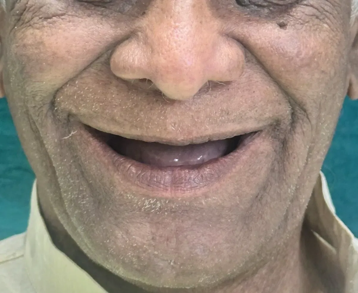 Full Mouth Rehabilitation — before treatment at Shayona Dental