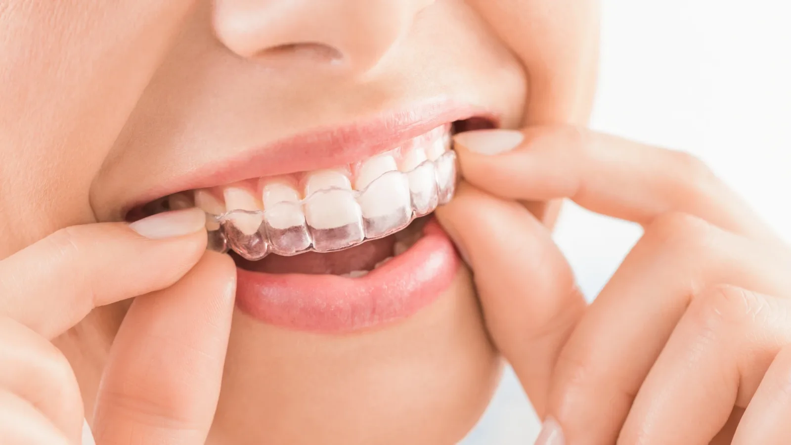 Clear Aligners & Invisalign