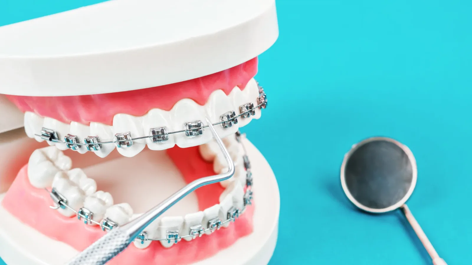 Dental Braces