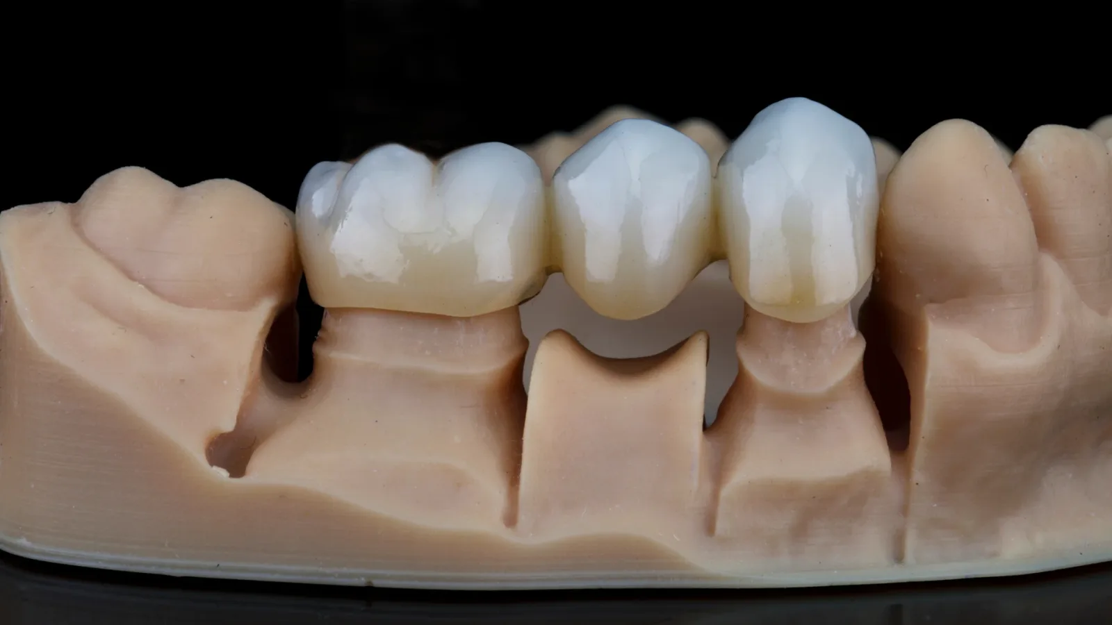 Dental Crowns and Bridges