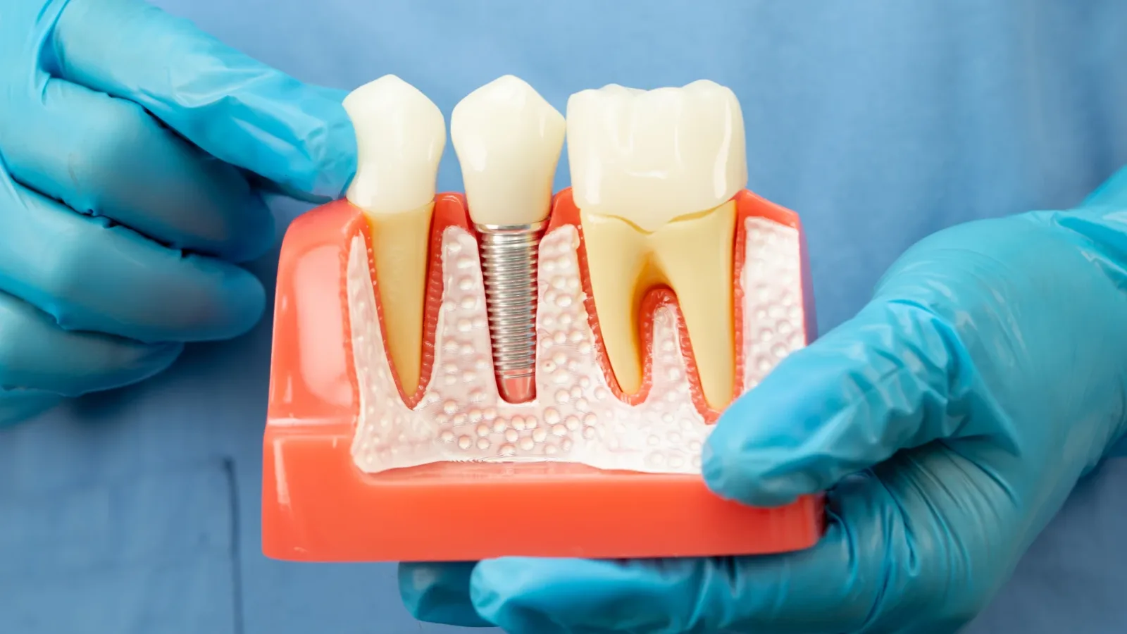 Dental Implants
