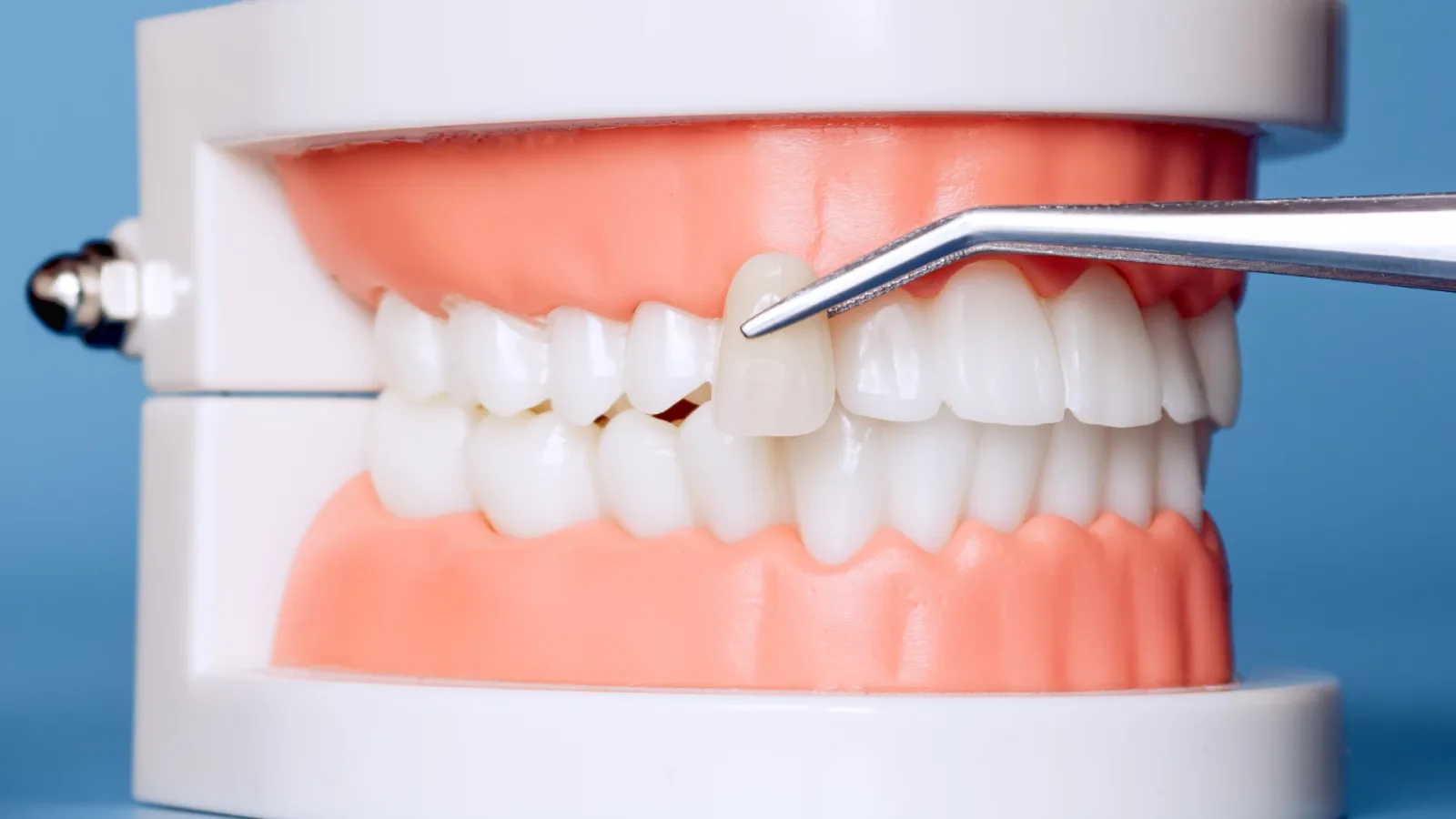 Dental Veneers