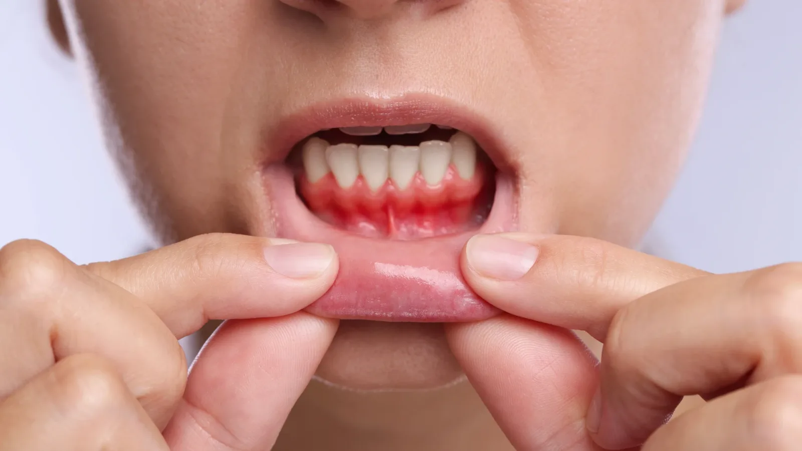 Gums Treatment