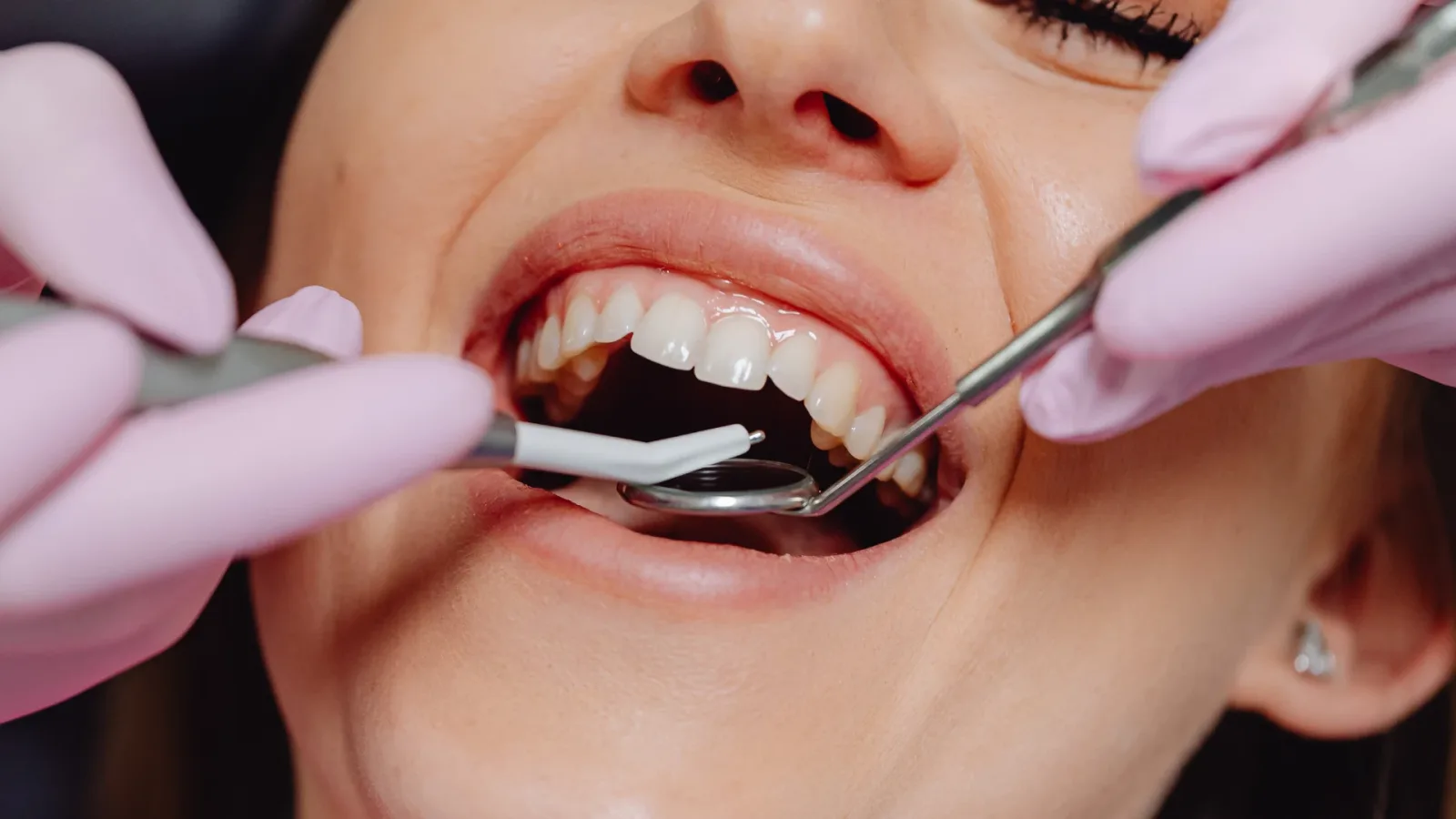 Root Canal Treatment