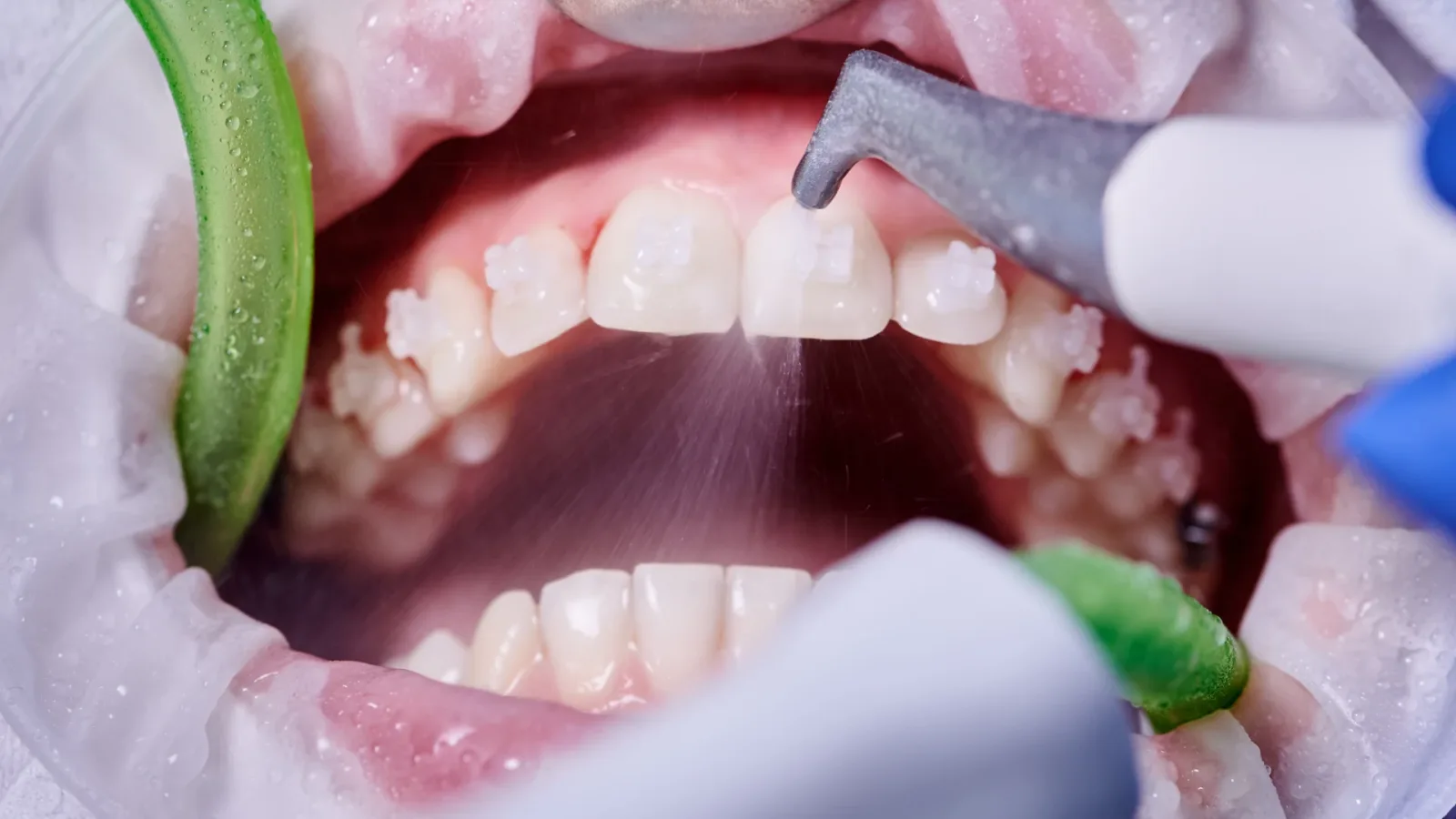 Teeth Cleaning & Polishing