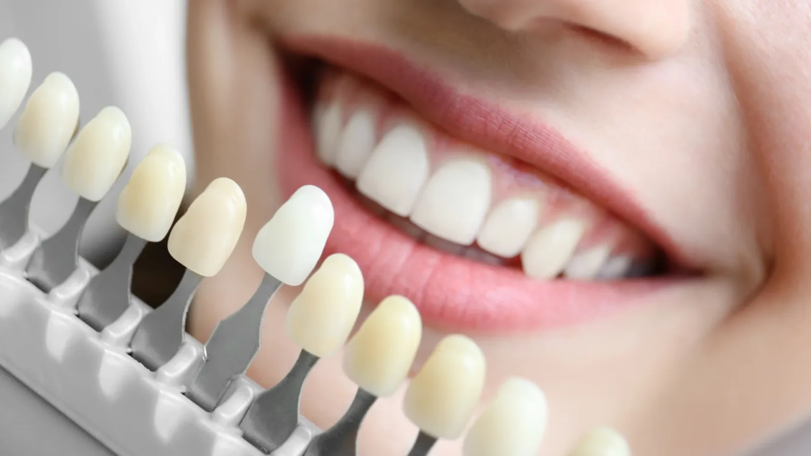 Teeth Whitening
