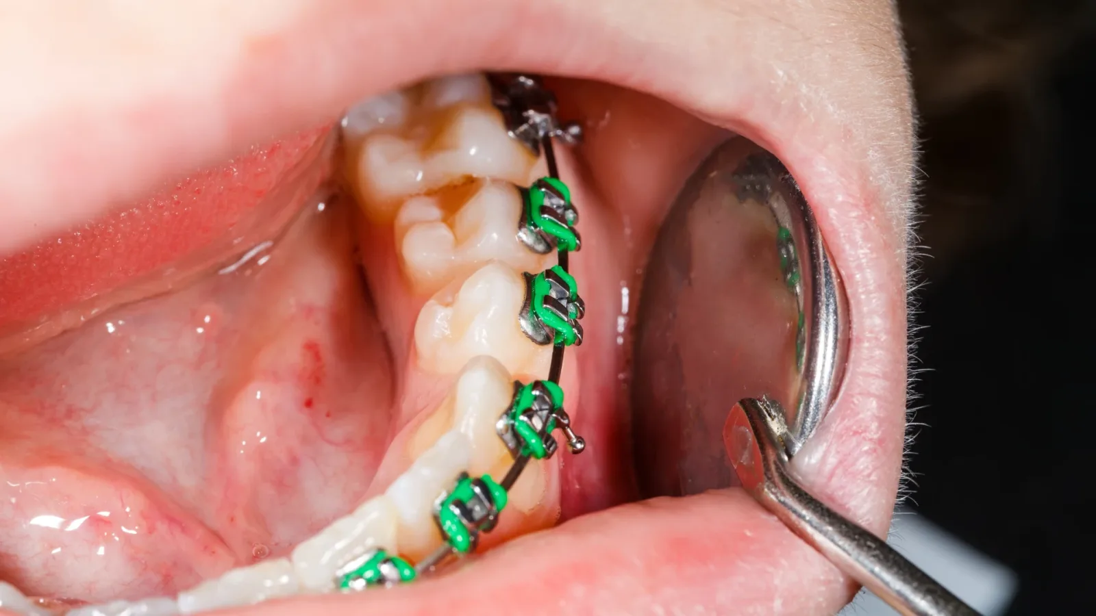 Tooth Bonding