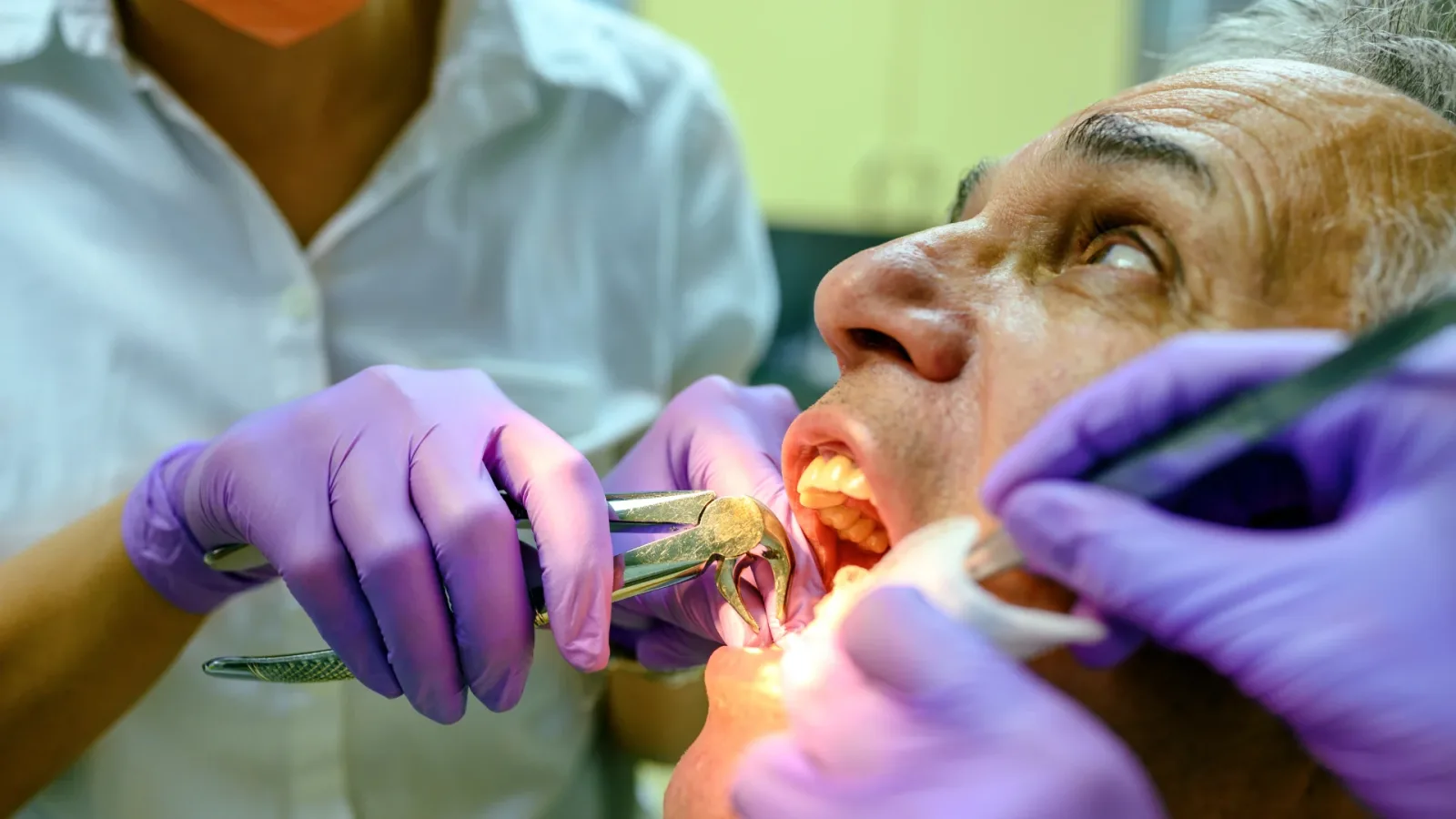 Tooth Extraction